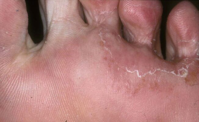ciuperca pielii degetelor de lângă unghii